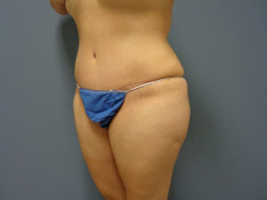 Abdominoplasty - Tummy Tuck Before and After Pictures Nashville, TN