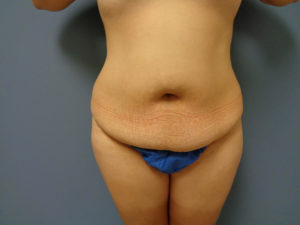 Abdominoplasty - Tummy Tuck Before and After Pictures Nashville, TN