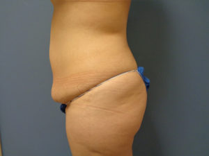 Abdominoplasty - Tummy Tuck Before and After Pictures Nashville, TN