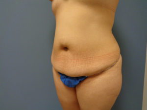 Abdominoplasty - Tummy Tuck Before and After Pictures Nashville, TN