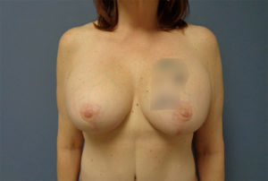 Breast Augmentation with Lift Before and After Pictures Nashville, TN