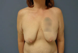 Breast Augmentation with Lift Before and After Pictures Nashville, TN