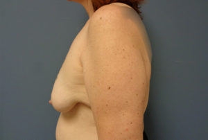 Breast Augmentation with Lift Before and After Pictures Nashville, TN