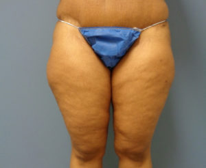 Thigh Lift Before and After Pictures Nashville, TN