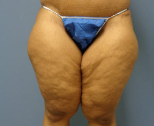 Thigh Lift Before and After Pictures Nashville, TN