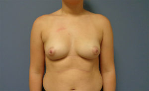 Breast Augmentation Before and After Pictures Nashville, TN