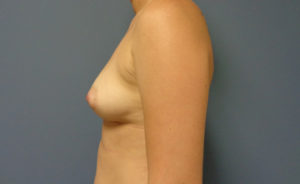 Breast Augmentation Before and After Pictures Nashville, TN