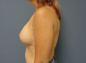 Breast Augmentation with Lift Before and After Pictures Nashville, TN