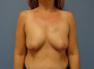 Breast Augmentation with Lift Before and After Pictures Nashville, TN