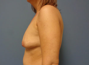 Breast Augmentation with Lift Before and After Pictures Nashville, TN