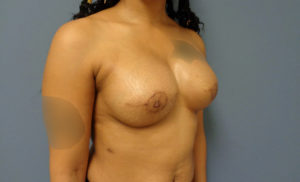 Implant Based Reconstruction Before and After Pictures Nashville, TN