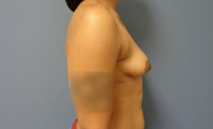 Implant Based Reconstruction Before and After Pictures Nashville, TN