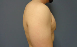 Gynecomastia Before & After Pictures in Nashville, TN