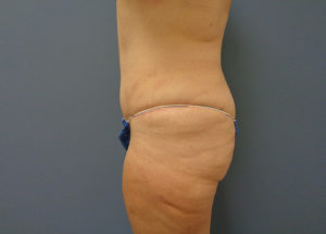 Tummy Tuck Before and After Pictures Nashville, TN