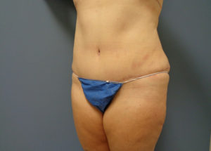 Tummy Tuck Before and After Pictures Nashville, TN