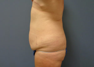 Tummy Tuck Before and After Pictures Nashville, TN