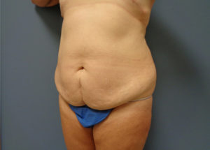 Tummy Tuck Before and After Pictures Nashville, TN