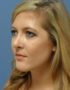 Rhinoplasty Before and After Pictures Nashville, TN