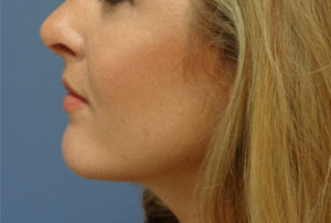 Chin Augmentation Before and After Pictures Nashville, TN