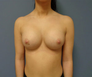 Breast Augmentation Before and After Pictures Nashville, TN