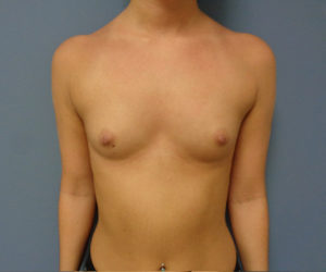 Breast Augmentation Before and After Pictures Nashville, TN