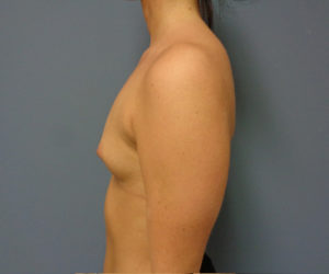 Breast Augmentation Before and After Pictures Nashville, TN