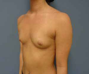 Breast Augmentation Before and After Pictures Nashville, TN