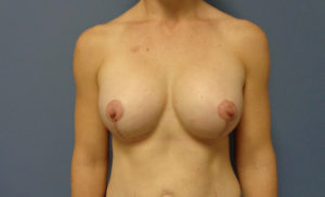 Breast Augmentation with Lift Before and After Pictures Nashville, TN