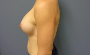 Breast Augmentation with Lift Before and After Pictures Nashville, TN