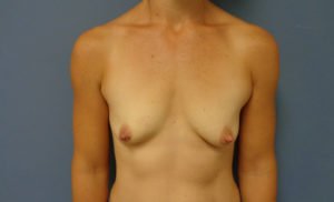 Breast Augmentation with Lift Before and After Pictures Nashville, TN