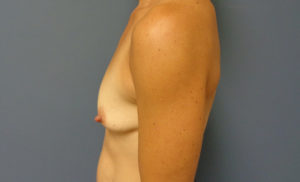 Breast Augmentation with Lift Before and After Pictures Nashville, TN