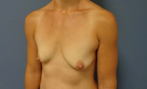 Breast Augmentation with Lift Before and After Pictures Nashville, TN