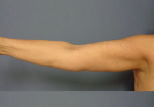 Arm Lift Before and After Pictures Nashville, TN