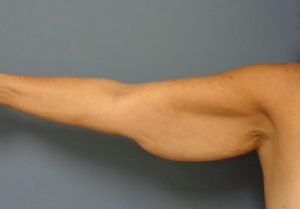 Arm Lift Before and After Pictures Nashville, TN