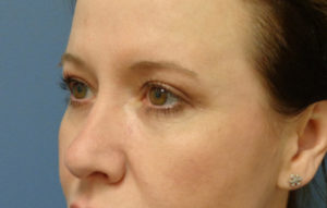 Blepharoplasty Before and After Pictures Nashville, TN