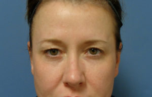 Blepharoplasty Before and After Pictures Nashville, TN