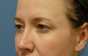 Blepharoplasty Before and After Pictures Nashville, TN