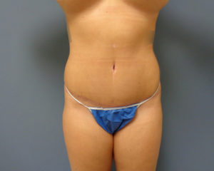 Tummy Tuck Before and After Pictures Nashville, TN