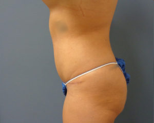 Tummy Tuck Before and After Pictures Nashville, TN