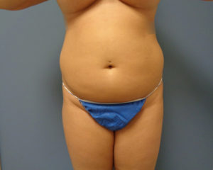 Tummy Tuck Before and After Pictures Nashville, TN