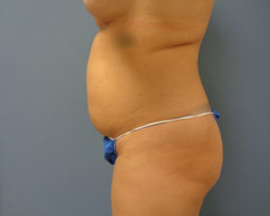 Tummy Tuck Before and After Pictures Nashville, TN