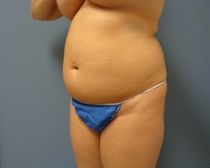 Tummy Tuck Before and After Pictures Nashville, TN