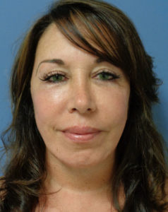 Facelift Before and After Pictures Nashville, TN