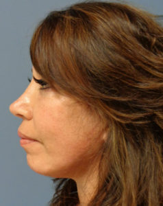 Facelift Before and After Pictures Nashville, TN