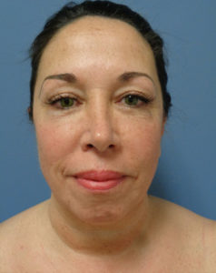 Facelift Before and After Pictures Nashville, TN