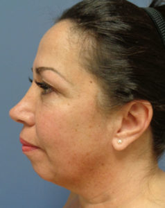 Facelift Before and After Pictures Nashville, TN