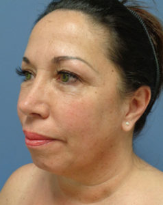 Facelift Before and After Pictures Nashville, TN