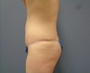 Tummy Tuck Before and After Pictures Nashville, TN