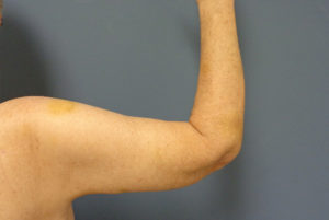 Arm Lift Before and After Pictures Nashville, TN