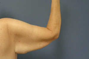 Arm Lift Before and After Pictures Nashville, TN